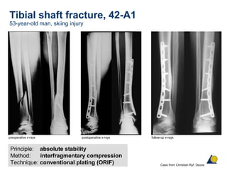 Tibial shaft fracture, 42-A1
53-year-old man, skiing injury
Principle: absolute stability
Method: interfragmentary compression
Technique: conventional plating (ORIF)
first step
preoperative x-rays postoperative x-rays follow-up x-rays
Case from Christian Ryf, Davos
 