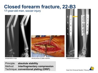Closed forearm fracture, 22-B3
17-year-old man, soccer injury
1.
1.
3.
2.
Principle: absolute stability
Method: interfragmentary compression
Technique: conventional plating (ORIF)
preoperative x-rays postoperative x-rays
Case from Emanuel Gautier, Fribourg
clincal picture of plate insertion
 