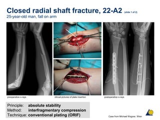 Closed radial shaft fracture, 22-A2 (slide 1 of 2)
25-year-old man, fall on arm
Principle: absolute stability
Method: interfragmentary compression
Technique: conventional plating (ORIF)
preoperative x-rays postoperative x-rays
Case from Michael Wagner, Wien
clincal pictures of plate insertion
 