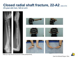 Closed radial shaft fracture, 22-A2 (slide 2 of 2)
25-year-old man, fall on arm
Case from Michael Wagner, Wien
follow-up x-rays and clinical pictures 6 weeks postoperatively
 