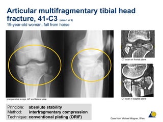 Articular multifragmentary tibial head
fracture, 41-C3 (slide 1 of 2)
19-year-old woman, fall from horse
Principle: absolute stability
Method: interfragmentary compression
Technique: conventional plating (ORIF) Case from Michael Wagner, Wien
preoperative x-rays, AP and lateral view CT scan in sagittal plane
CT scan on frontal plane
 