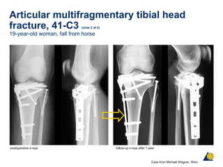 Articular multifragmentary tibial head
fracture, 41-C3 (slide 2 of 2)
19-year-old woman, fall from horse
Case from Michael Wagner, Wien
postoperative x-rays follow-up x-rays after 1 year
 