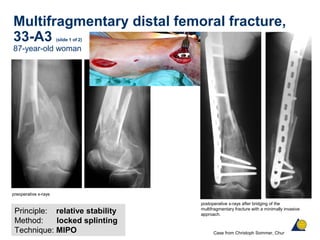 Multifragmentary distal femoral fracture,
33-A3 (slide 1 of 2)
87-year-old woman
Principle: relative stability
Method: locked splinting
Technique: MIPO
preoperative x-rays
postoperative x-rays after bridging of the
multifragmentary fracture with a minimally invasive
approach.
follow-up x-rays
Case from Christoph Sommer, Chur
 