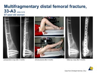 Multifragmentary distal femoral fracture,
33-A3 (slide 2 of 2)
87-year-old woman
postoperative x-rays after 3 months clinical pictures after 3 months follow-up x-rays after 5 months
Case from Christoph Sommer, Chur
 