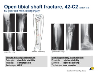 Open tibial shaft fracture, 42-C2 (slide 1 of 2)
50-year-old man, skiing injury
Simple metaphyseal fracture
Principle: absolute stability
Method: compression
Technique: ORIF
preoperative x-ray reduction and fixation postoperative x-rays
Case from Christian Ryf, Davos
Multifragmentary shaft fracture
Principle: relative stability
Method: locked splinting
Technique: less invasive
 