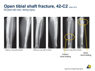 Open tibial shaft fracture, 42-C2 (slide 2 of 2)
50-year-old man, skiing injury
follow-up x-rays after 6 weeks follow-up x-rays after 6 months
Case from Christian Ryf, Davos
follow-up x-rays after 8 months
indirect
bone healing
direct
bone healing
 