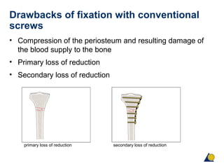 Drawbacks of fixation with conventional
screws
• Compression of the periosteum and resulting damage of
the blood supply to the bone
• Primary loss of reduction
• Secondary loss of reduction
primary loss of reduction secondary loss of reduction
 