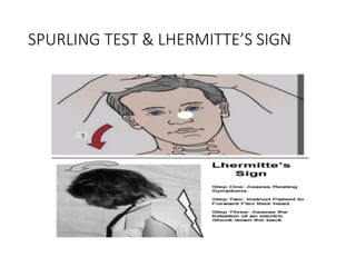 SPURLING TEST & LHERMITTE’S SIGN
 