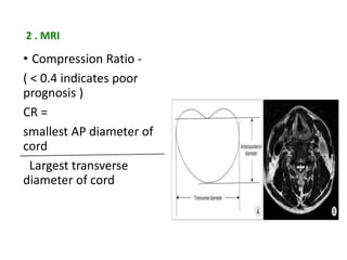 2 . MRI
• Compression Ratio -
( < 0.4 indicates poor
prognosis )
CR =
smallest AP diameter of
cord
Largest transverse
diameter of cord
 