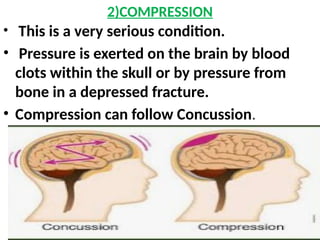 2)COMPRESSION
• This is a very serious condition.
• Pressure is exerted on the brain by blood
clots within the skull or by pressure from
bone in a depressed fracture.
• Compression can follow Concussion.
 