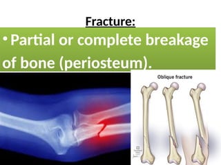 Fracture:
• Partial or complete breakage
of bone (periosteum).
 