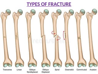 TYPES OF FRACTURE
 