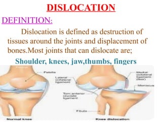 DISLOCATION
DEFINITION:
Dislocation is defined as destruction of
tissues around the joints and displacement of
bones.Most joints that can dislocate are;
Shoulder, knees, jaw,thumbs, fingers
 