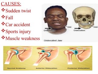 CAUSES:
Sudden twist
Fall
Car accident
Sports injury
Muscle weakness
 