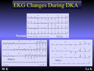 EKG Changes During DKA




       Normal




Hi K                            Lo K
 