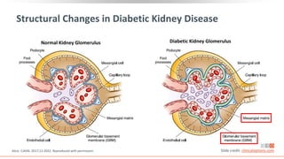 Structural Changes in Diabetic Kidney Disease
Alicic. CJASN. 2017;12:2032. Reproduced with permission.
Normal Kidney Glomerulus Diabetic Kidney Glomerulus
Slide credit: clinicaloptions.com
 