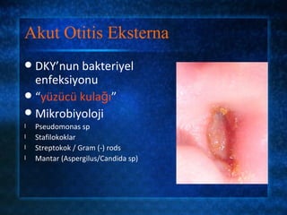 Akut Otitis Eksterna
 DKY’nun bakteriyel
  enfeksiyonu
 “yüzücü kulağı”
 Mikrobiyoloji
l   Pseudomonas sp
l   Stafilokoklar
l   Streptokok / Gram (-) rods
l   Mantar (Aspergilus/Candida sp)
 