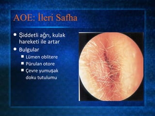 AOE: İleri Safha
   Şiddetli ağrı, kulak
    hareketi ile artar
   Bulgular
       Lümen oblitere
       Pürulan otore
       Çevre yumuşak
        doku tutulumu
 