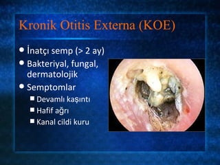 Kronik Otitis Externa (KOE)
 İnatçı semp (> 2 ay)
 Bakteriyal, fungal,
  dermatolojik
 Semptomlar
     Devamlı kaşıntı
     Hafif ağrı
     Kanal cildi kuru
 
