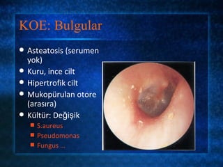 KOE: Bulgular
   Asteatosis (serumen
    yok)
   Kuru, ince cilt
   Hipertrofik cilt
   Mukopürulan otore
    (arasıra)
   Kültür: Değişik
       S.aureus
       Pseudomonas
       Fungus …
 