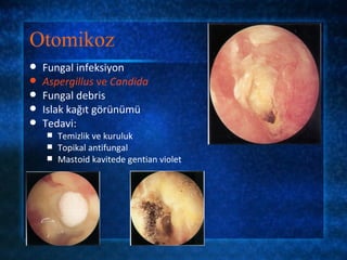 Otomikoz
   Fungal infeksiyon
   Aspergillus ve Candida
   Fungal debris
   Islak kağıt görünümü
   Tedavi:
     Temizlik ve kuruluk
     Topikal antifungal
     Mastoid kavitede gentian violet
 