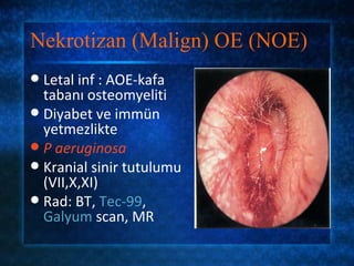 Nekrotizan (Malign) OE (NOE)
 Letal inf : AOE-kafa
  tabanı osteomyeliti
 Diyabet ve immün
  yetmezlikte
 P aeruginosa
 Kranial sinir tutulumu
  (VII,X,XI)
 Rad: BT, Tec-99,
  Galyum scan, MR
 