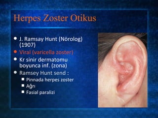 Herpes Zoster Otikus
   J. Ramsay Hunt (Nörolog)
    (1907)
   Viral (varicella zoster)
   Kr sinir dermatomu
    boyunca inf. (zona)
   Ramsey Hunt send :
       Pinnada herpes zoster
       Ağrı
       Fasial paralizi
 