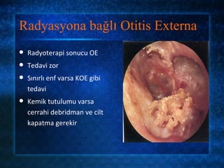 Radyasyona bağlı Otitis Externa
   Radyoterapi sonucu OE
   Tedavi zor
   Sınırlı enf varsa KOE gibi
    tedavi
   Kemik tutulumu varsa
    cerrahi debridman ve cilt
    kapatma gerekir
 