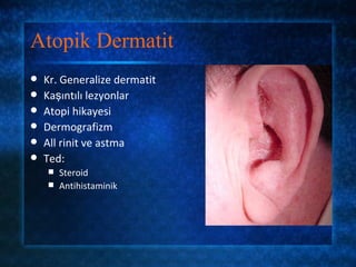 Atopik Dermatit
   Kr. Generalize dermatit
   Kaşıntılı lezyonlar
   Atopi hikayesi
   Dermografizm
   All rinit ve astma
   Ted:
     Steroid
     Antihistaminik
 