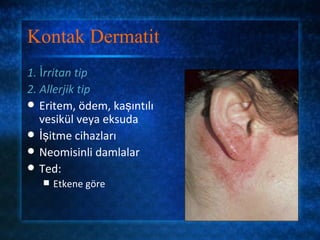 Kontak Dermatit
1. İrritan tip
2. Allerjik tip
 Eritem, ödem, kaşıntılı
   vesikül veya eksuda
 İşitme cihazları
 Neomisinli damlalar
 Ted:
      Etkene göre
 