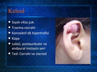 Keloid
   Siyah ırkta çok
   Travma-cerrahi
   Konnektif dk hipertrofisi
   Küpe
   Lobül, postaurikuler ve
    endaural insizyon yeri
   Ted: Cerrahi ve steroid
 