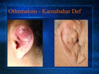 Othematom - Karnabahar Def
 