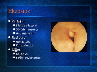Ekzostoz
   Yerleşim
       Sıklıkla bilateral
       Sütürler boyunca
       Anulusa yakın
   Radiografi
       Geniş taban
       Kortex intact
   Diğer
       Dalgıç vs.
       Soğuk suyla temas
 