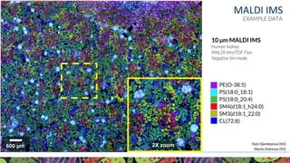 Visit KPMP.org for more information
KIDNEY PRECISION MEDICINE PROJECT
Martin Dufresne (VU)
10 µm MALDI IMS
Human kidney
MALDI timsTOF Flex
Negative Ion mode
600 µm 2X zoom
PE(O-38:5)
PS(18:0_18:1)
PS(18:0_20:4)
SM4(d18:1_h24:0)
SM3(d18:1_22:0)
CL(72:8)
MALDI IMS
Kate Djambazova (VU)
EXAMPLE DATA
 