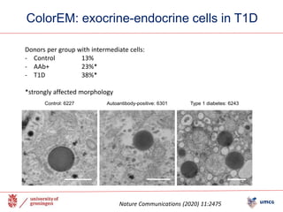 ColorEM: exocrine-endocrine cells in T1D
Type 1 diabetes: 6243
Control: 6227 Autoantibody-positive: 6301
Donors per group with intermediate cells:
- Control 13%
- AAb+ 23%*
- T1D 38%*
*strongly affected morphology
Nature Communications (2020) 11:2475
 