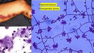 • Sporotrichosis
• temperate zones
 