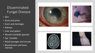 Disseminated
Fungal Disease
• Skin
• bone and joints
• brain and meninges
• Kidneys
• Liver and spleen
• Muscle (Candida species)
• Eye Candida
• Nasal passages and sinuses
• Bloodstream and bone
marrow
 