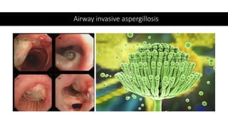 Airway invasive aspergillosis
 