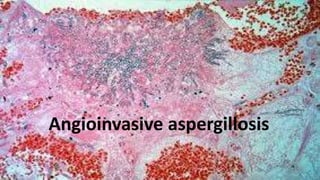 Angioinvasive aspergillosis
 
