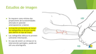 Estudios de imagen
 Se requiere como mínimo dos
proyecciones de la extremidades
afectada en posición
anteroposterior y lateral.
 La tracción al momento de tomar
las radiografías es de gran ayuda
para definir el tipo de trazo.
 Las radiografías oblicua no proveen
suficiente información.
 En caso de existir un retraso en la
intervención quirúrgica, puede ser
útil una arteriografía.
 