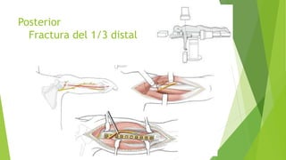 Posterior
Fractura del 1/3 distal
 