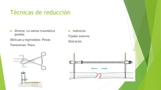 Técnicas de reducción
 Directa: Lo menos traumática
posible.
Oblicuas y espiroideas: Pinzas
Transversas: Placa
 Indirecta:
Fijador externo
Distractor
 