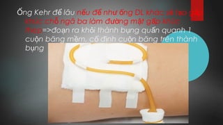 ng Kehr đ lâuỐ ể n u đ nh ng DL khác s t o g pế ể ư ố ẽ ạ ấ
khúc ch ngã ba làm đ ng m t g p khúcỗ ườ ậ ấ
thep=>đo n ra kh i thành b ng qu n quanh 1ạ ỏ ụ ấ
cu n băng m m, c đ nh cu n băng trên thànhộ ề ố ị ộ
b ngụ
 