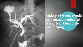 Không còn sỏi, thuốc
cản quang xuống tá
tràng tốt, không dò
vào ổ bụng
 