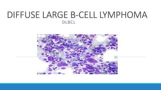 DIFFUSE LARGE B-CELL LYMPHOMA
DLBCL
 