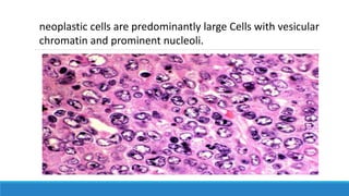neoplastic cells are predominantly large Cells with vesicular
chromatin and prominent nucleoli.
 