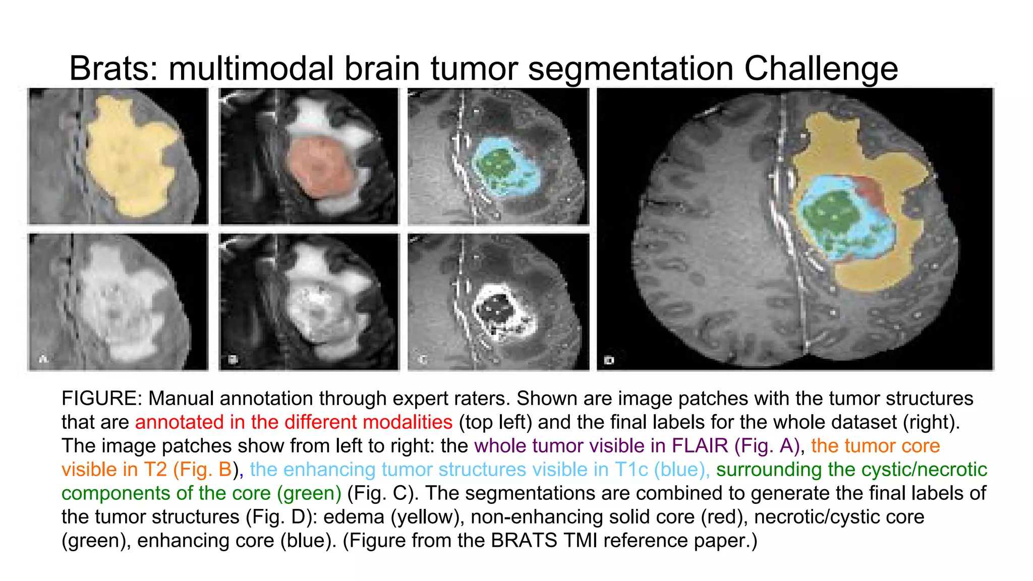 FIGURE: Manual annotation through expert raters. Shown are image patches with the tumor structures
that are annotated in the different modalities (top left) and the final labels for the whole dataset (right).
The image patches show from left to right: the whole tumor visible in FLAIR (Fig. A), the tumor core
visible in T2 (Fig. B), the enhancing tumor structures visible in T1c (blue), surrounding the cystic/necrotic
components of the core (green) (Fig. C). The segmentations are combined to generate the final labels of
the tumor structures (Fig. D): edema (yellow), non-enhancing solid core (red), necrotic/cystic core
(green), enhancing core (blue). (Figure from the BRATS TMI reference paper.)
Brats: multimodal brain tumor segmentation Challenge
 