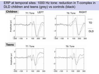 ERP at temporal sites: 1000 Hz tone: reduction in T-complex in
DLD children and teens (grey) vs controls (black)
Children
Teens
TD
DLD
LEFT RIGHT
 