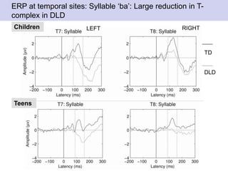 ERP at temporal sites: Syllable ‘ba’: Large reduction in T-
complex in DLD
Children
Teens
TD
DLD
LEFT RIGHT
 