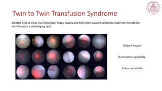 Twin to Twin Transfusion Syndrome
Limited field of view, low fetoscopic image quality and high inter-subject variability make the membrane
identification a challenging task.
Texture Paucity
Illumination variability
Colour variability
 